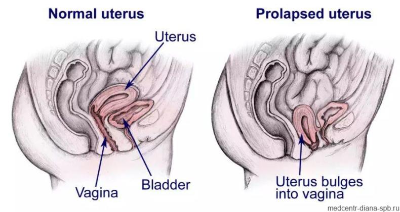 Акушерский пессарий при укорочении шейки матки у беременных