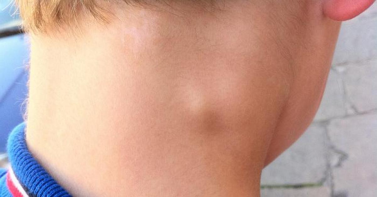 Шишка на шее у ребенка — причины появления уплотнения