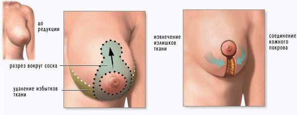 Красивая грудь после родов: это реально?