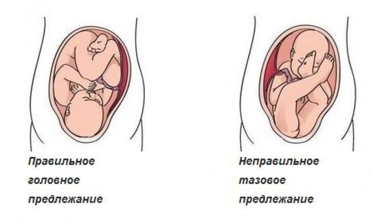 Кесарево сечение или нет? особенности ведения беременности и родов при тазовом предлежании плода