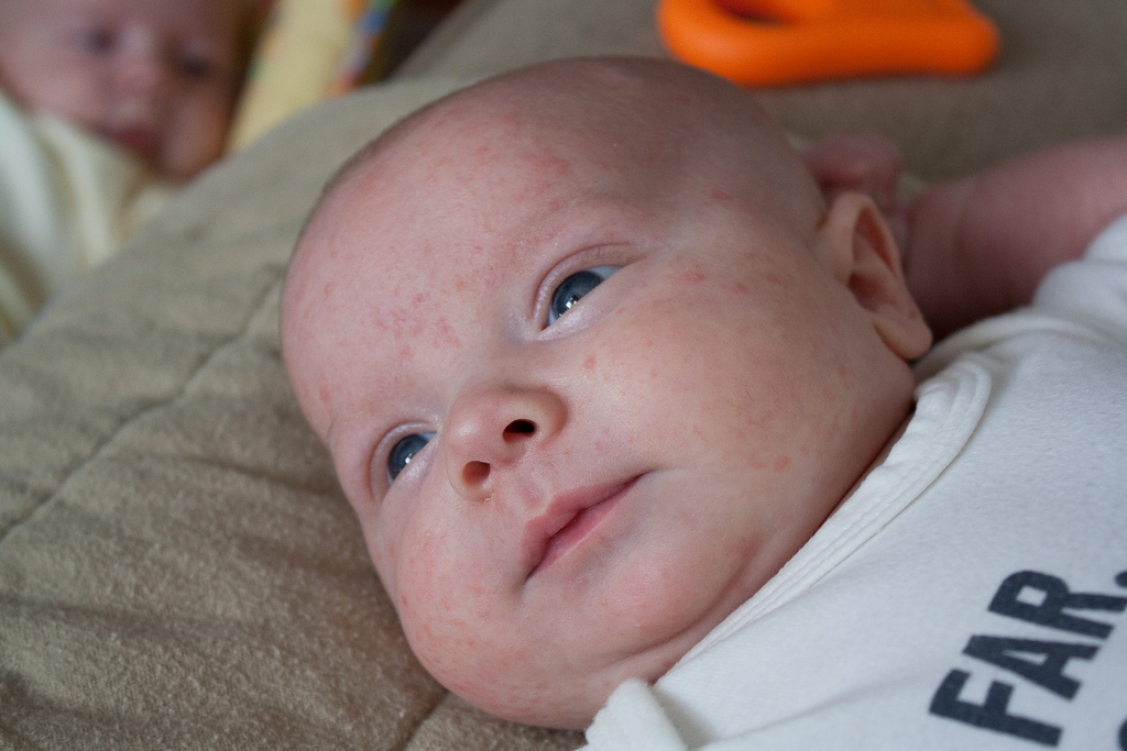 Симптомы мраморной кожи при высокой температуре у ребенка