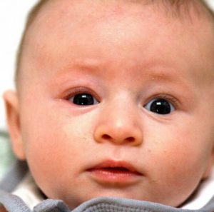 Дакриоцистит у новорожденных: как помочь крохе