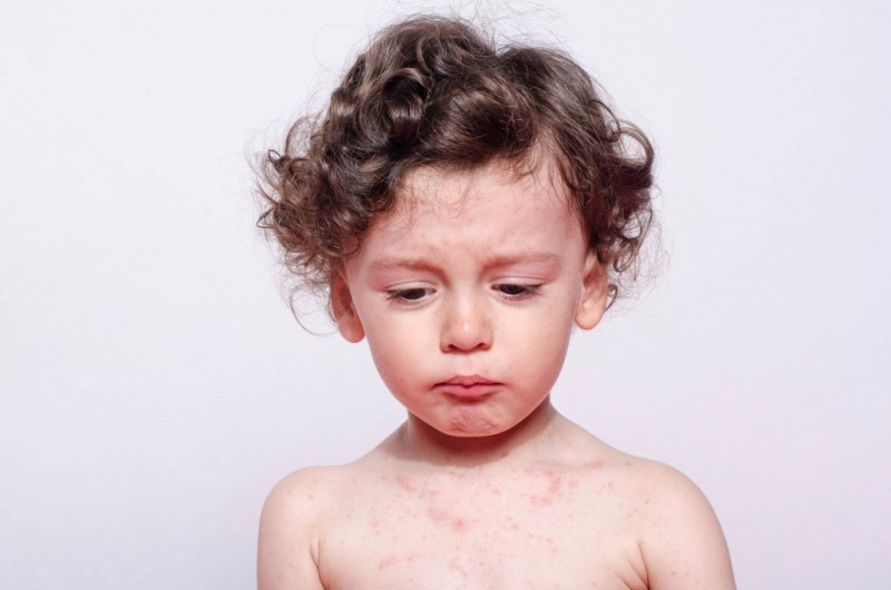 Аллергия у грудничка на лице