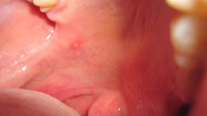 Сыпь во рту у ребенка — возможные причины