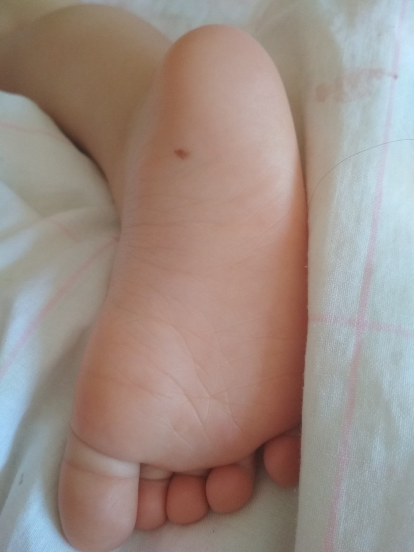 Почему родинка у ребенка растет на теле, лице — что делать