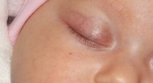 Красные глаза у ребенка — виды покраснений, причины, симптомы