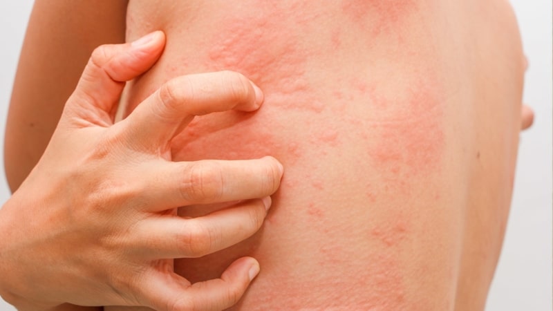 Как отличить потницу от аллергии у грудничка