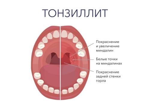 Тонзиллит: причины возникновения, симптомы и лечение