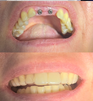 Имплантация зубов: как вернуть улыбку