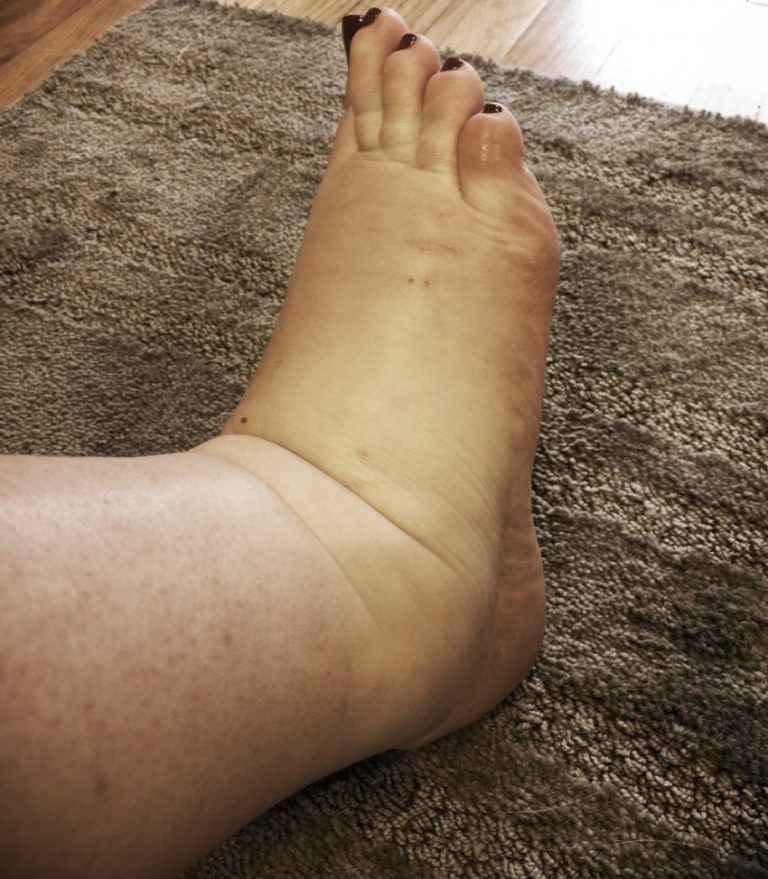Отёки ног при беременности - «институт вен» лечение варикоза в киеве и харькове