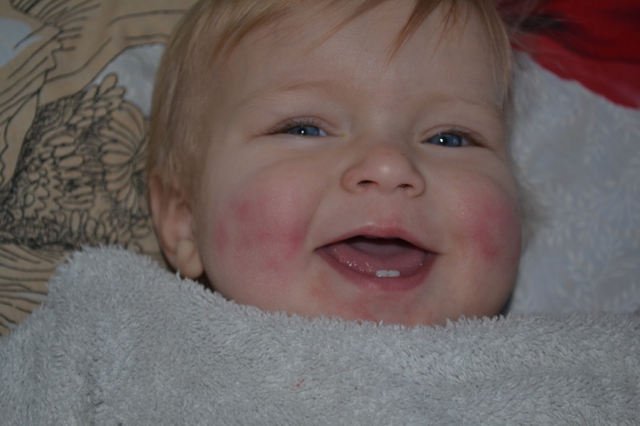 Аллергия на солнце у малыша
