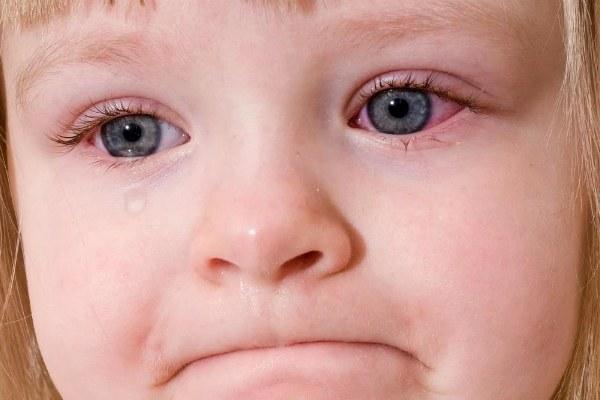 Красные глаза у ребенка — виды покраснений, причины, симптомы