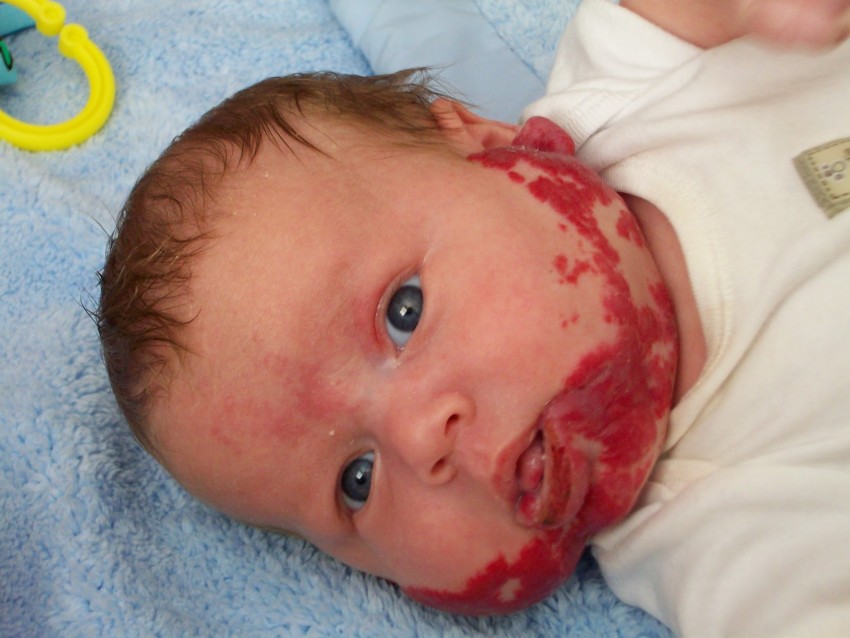 Почему родинка у ребенка растет на теле, лице — что делать