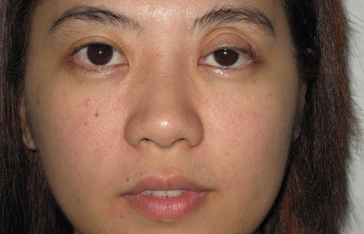 Почему у новорожденного один глаз открывается больше другого