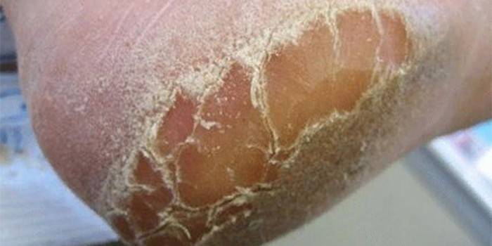Трещины кожи пяток — лечение и профилактика