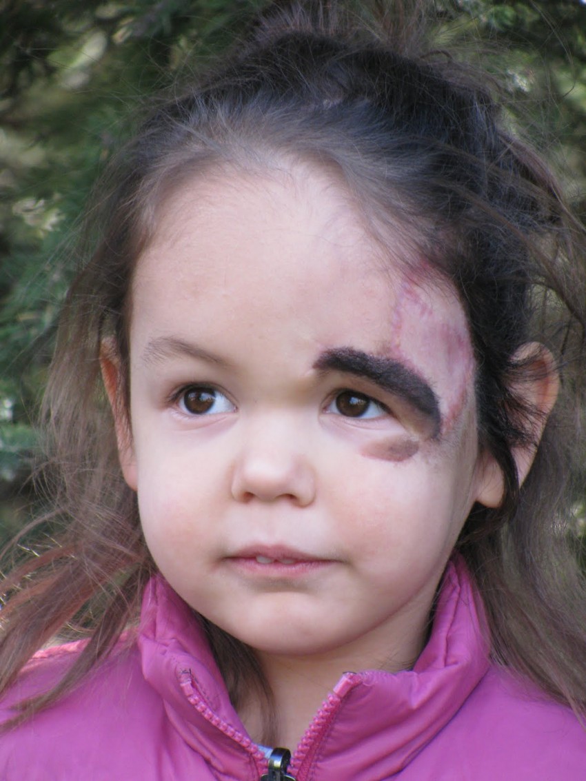 Почему родинка у ребенка растет на теле, лице — что делать