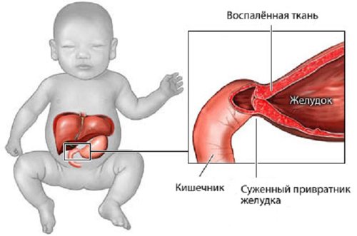 Пилоростеноз у новорожденных —причины, симптоматика, диагностика