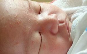 Сыпь на лице и на голове новорожденного — что это такое