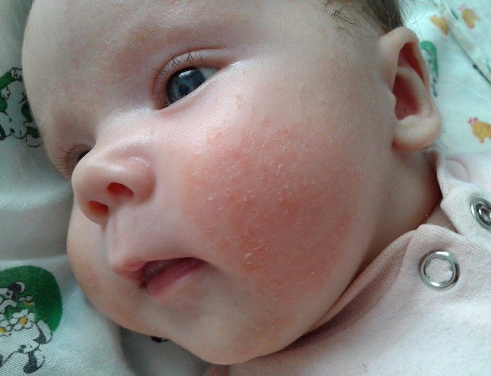 Сыпь у ребенка: аллергия, инфекция или укусы насекомых?