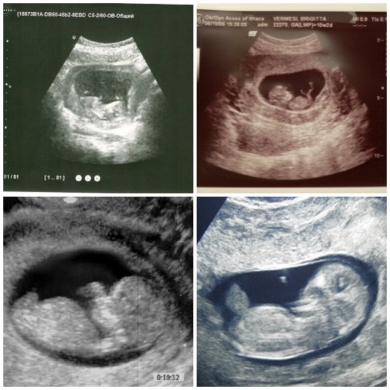 10 неделя беременности: у малыша сформировались внутренние органы, глаза, веки и уши.