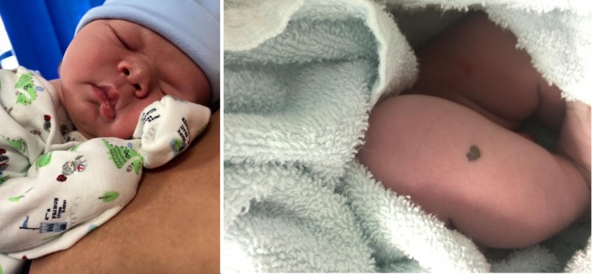 Почему родинка у ребенка растет на теле, лице — что делать