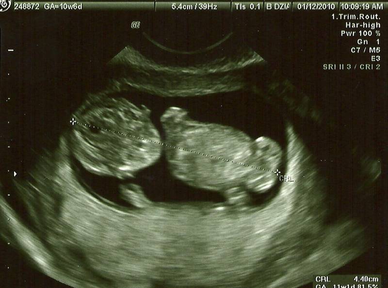 10 недель беременности – что происходит с мамой, развитие плода, ощущения, как выглядит живот - agulife.ru