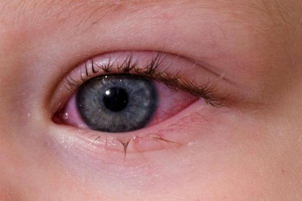 Почему красные глаза у новорожденного ребенка — что делать