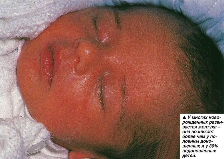 Всё о желтухе новорожденных. причины и проявления. опасные и неопасные желтушки