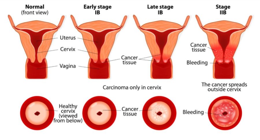 Эрозия шейки матки при беременности: стоит ли волноваться?