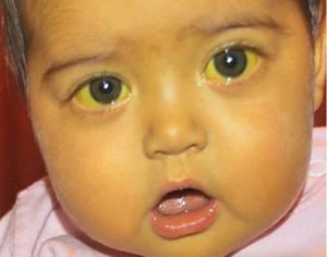 Почему бывают желтые белки глаз у новорожденных
