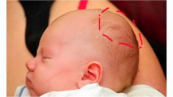 Гематомы при родах на голове у новорожденных