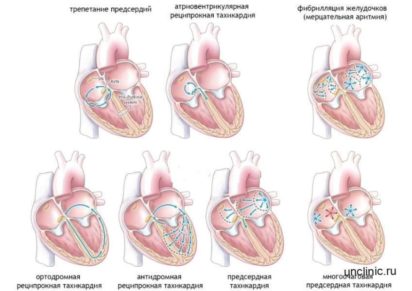 Тахикардия при беременности: причины, симптомы, лечение
