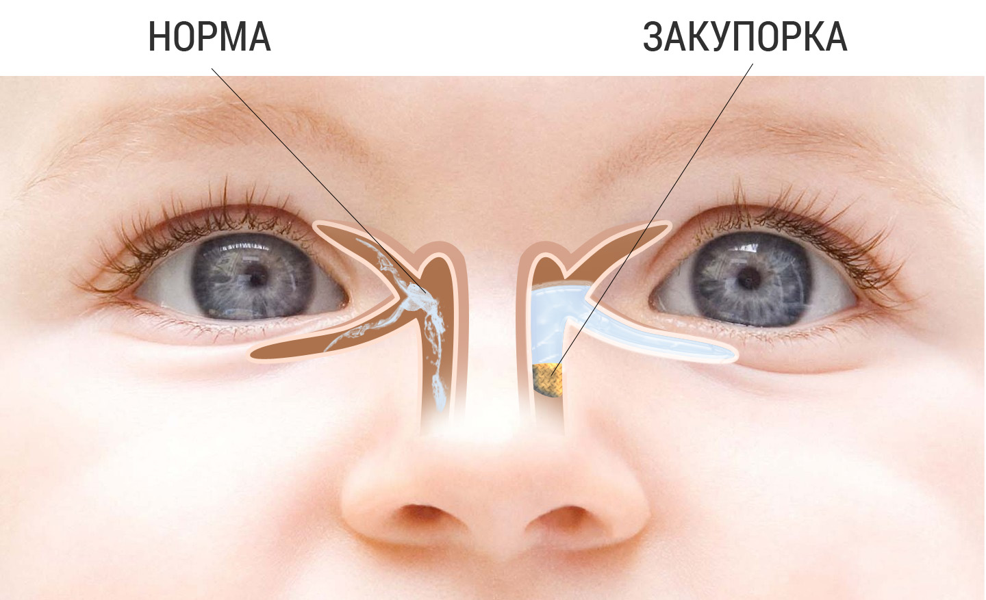 Гной в глазу у ребенка чем лечить. Дакриоцистит массаж слезного канала. Непроходимость слезного канала дакриоцистит. Дакриоцистит массаж слезного канала у новорожденных. Дакриоцистит новорожденных массаж слезного канала у новорожденных.