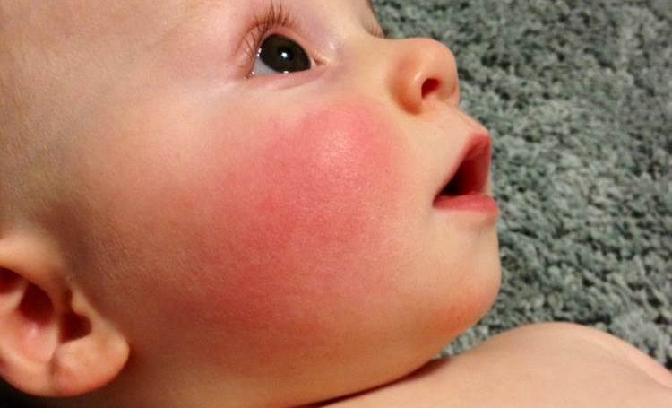 Аллергия на сладкое у ребенка до года — возможные проявления