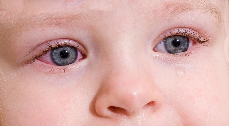 Почему гноятся глаза у ребенка, что делать, как удалить гной