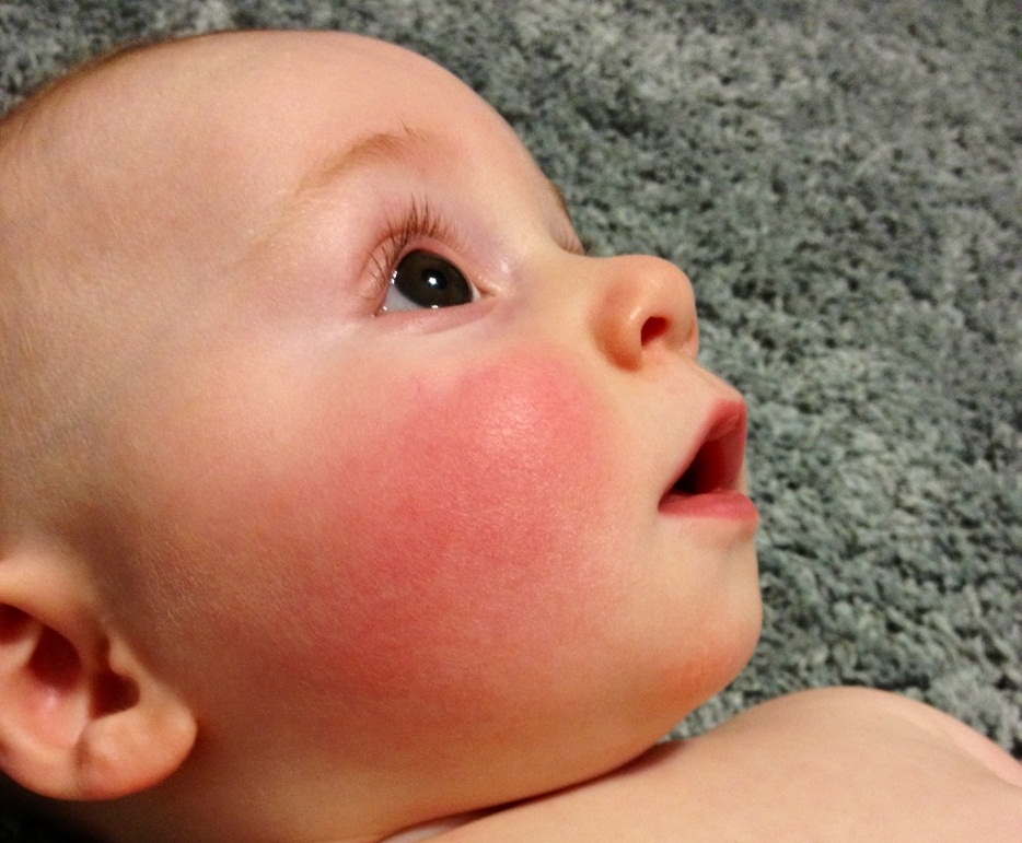 Красная кожа у новорожденного — причины, когда пройдет покраснение