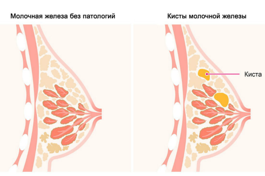 Шишка в груди при грудном вскармливании: устраняем проблему