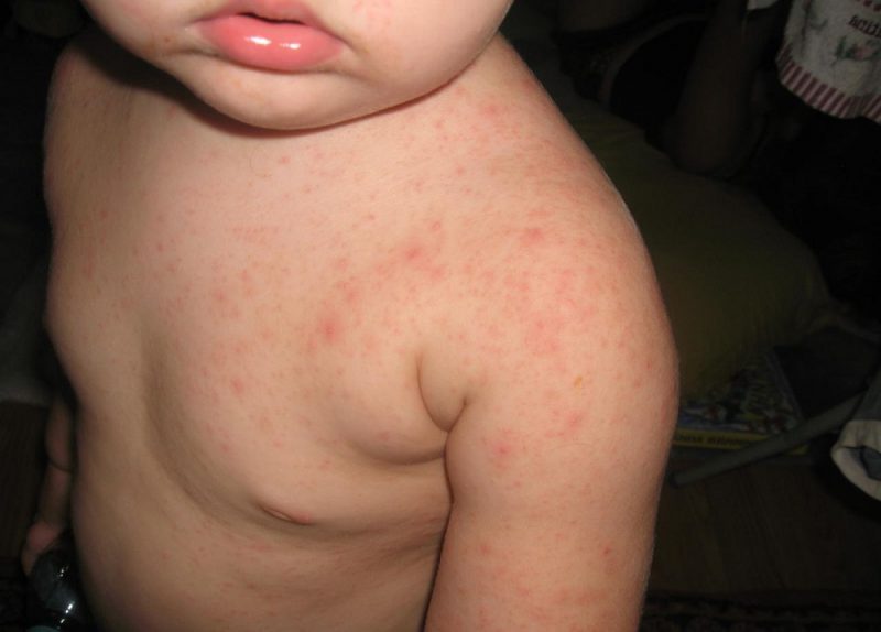 Сыпь на животе у ребенка — возможные причины