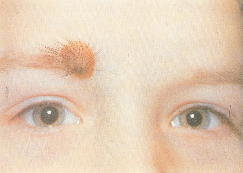 Почему родинка у ребенка растет на теле, лице — что делать