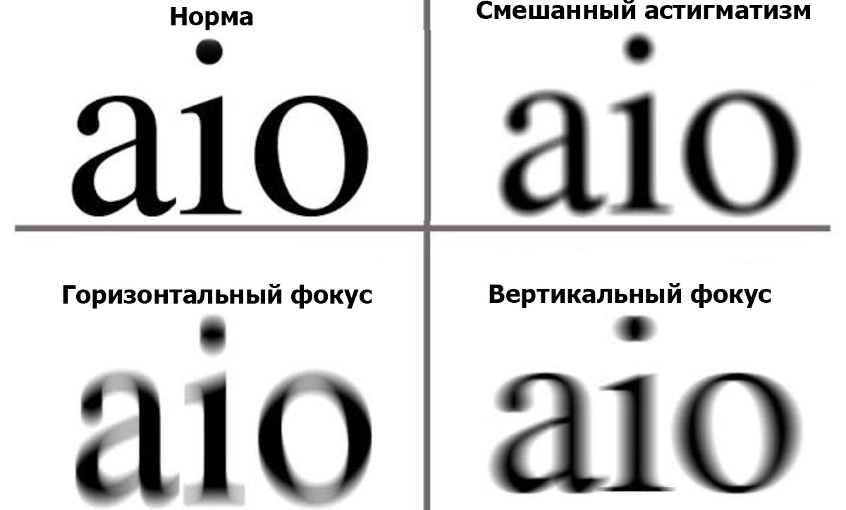 Астигматизм у ребенка — что это такое, нужно ли лечить