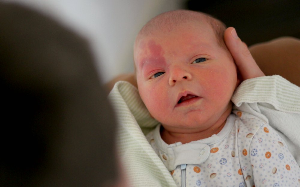 Игорь сай: красное пятнышко на лице новорожденного может быть опасной гемангиомой