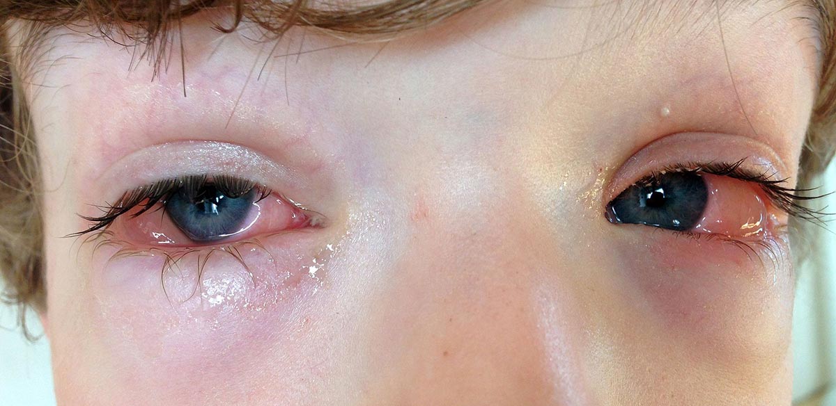 У ребенка гноится глазик – что делать, как и чем лечить?