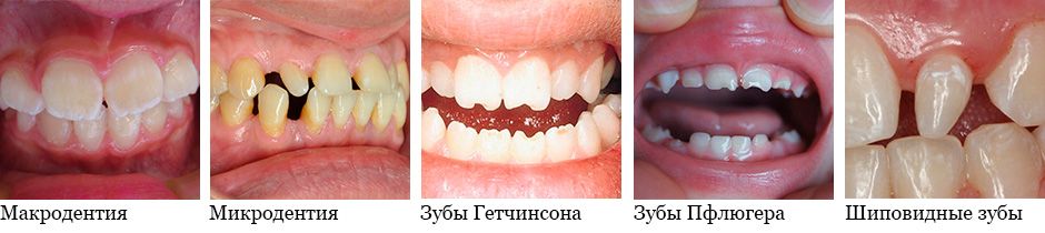 Могут ли в 2 месяца резаться зубы у грудничков