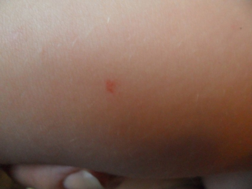 Почему родинка у ребенка растет на теле, лице — что делать