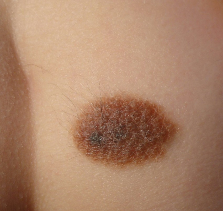 Почему родинка у ребенка растет на теле, лице — что делать