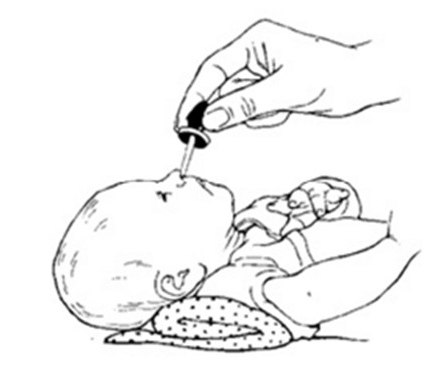 Отсасыватель соплей для новорожденных — как убрать сопли у грудничков