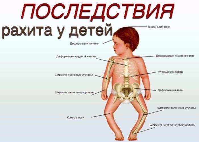 Все о рахите у грудных детей: симптомы, причины, лечение
