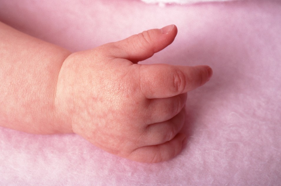 Мраморная кожа у ребенка младше года — причины и последствия