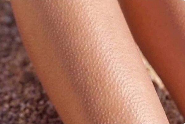 Гусиная кожа у ребенка — возможные причины появления