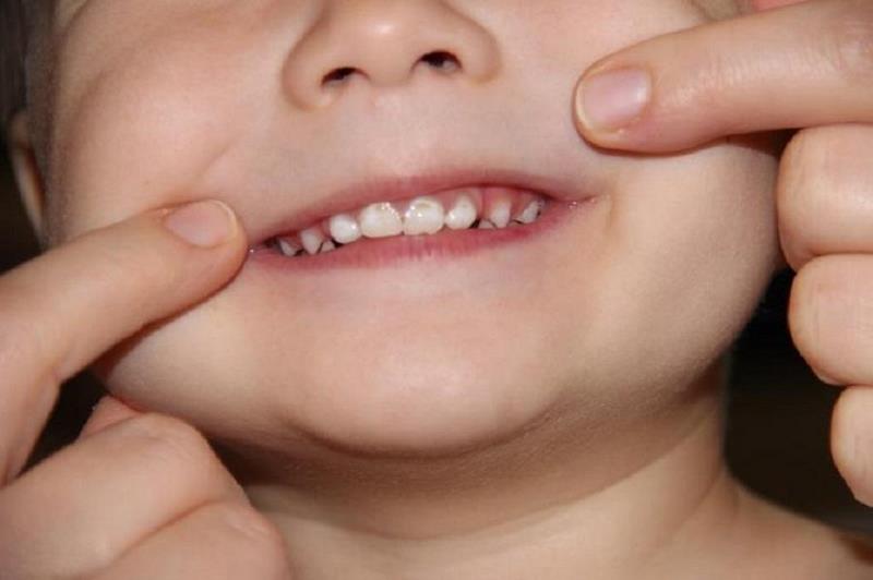 Какие зубы лезут первыми у ребенка — схема